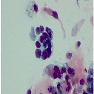 Bronchoalveolar lavage fluid cytology (× 600) showing small cell lung... | Download Scientific ...