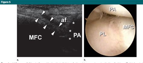 [PDF] Medial plica syndrome of the knee: diagnosis with dynamic sonography. | Semantic Scholar