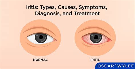 Iritis: Types, Causes, Symptoms, Diagnosis, and Treatment