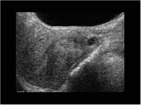 WK 3 L 2 Nabothian cyst longitudinalNabothian cyst with a cystic structure in the cervix in a ...