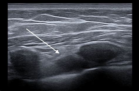 Supraclavicular Lymph Nodes Ultrasound - Ultrasound Of Superficial Lymph Nodes Sciencedirect ...