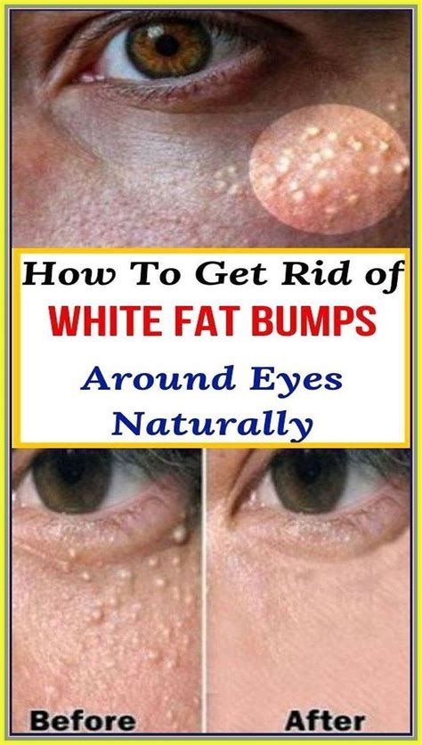 HOW TO GET RID OF WHITE FAT BUMPS AROUND EYES NATURALLY | Bumps under eyes, Skin care treatments ...