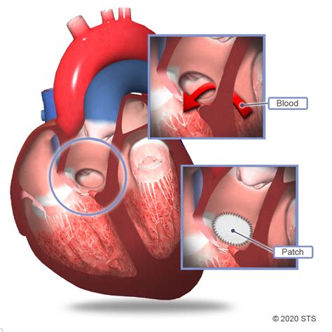 Ventricular Septal Defect Surgery | The Patient Guide to Heart, Lung ...