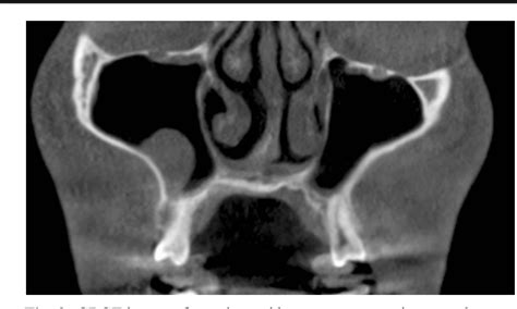 Maxillary Sinus Retention Cyst - slidesharetrick