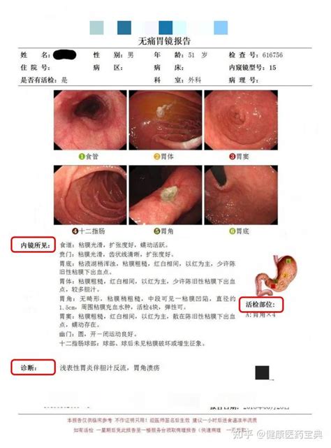 一文教你看懂胃镜检查报告 - 知乎