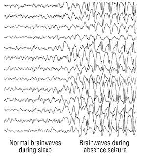 Brain Wave Patterns And Eeg – Patterns Gallery