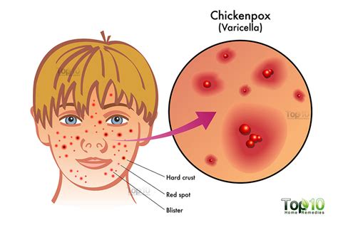 Chicken Pox (Herpes Varicella Zoster) - Apex Dermatology & Skin Surgery Center - Cleveland, OH ...