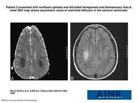 Patient 2 presented with nonfluent aphasia and left-sided hemiparesis ...