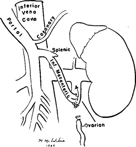 Portacaval Anastomosis Diagram