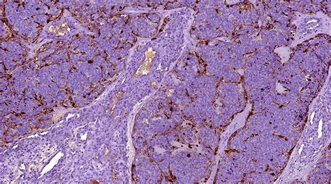 Pathology Outlines - Olfactory neuroblastoma