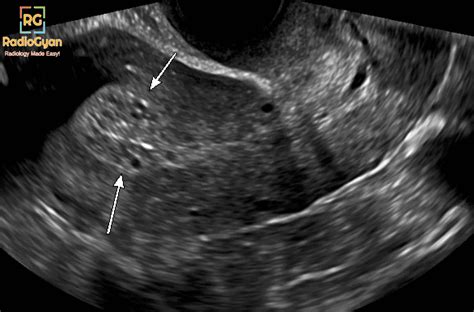 Tamoxifen-associated Endometrial Changes Ultrasound - RadioGyan