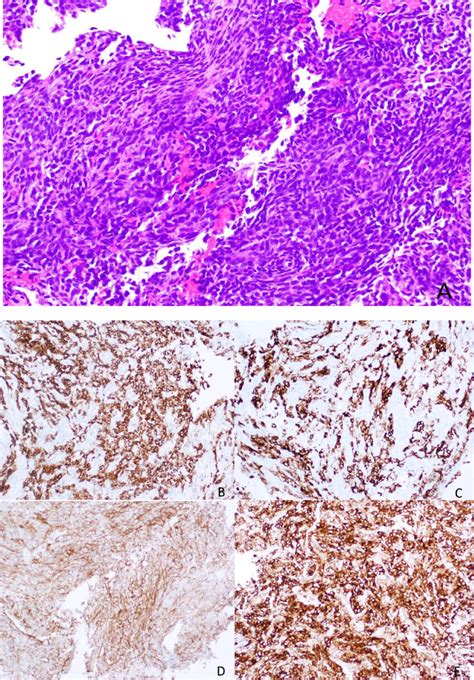 Histology of a SS, with a spindle cell morphology, sometimes with a ...