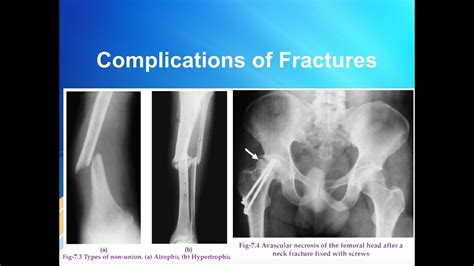 Complications of Fracture - YouTube