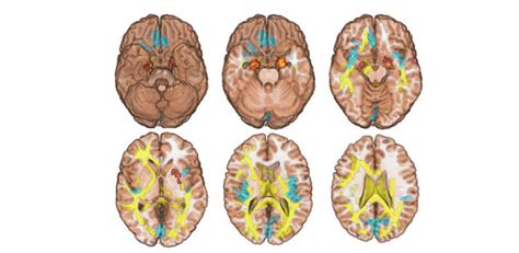 Siblings’ brain scans could hold the key to drug addiction | University of Cambridge