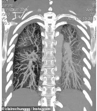 UNC Researchers Tackle the E-cigarette or Vaping Product Use–associated Lung Injury (EVALI ...