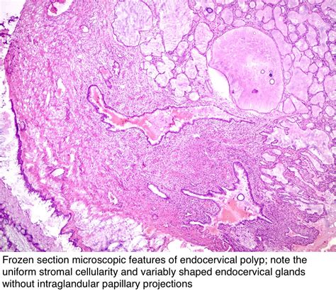 Pathology Outlines - Endocervical polyp