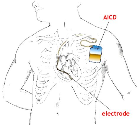 Pacemaker/AICD Interrogation — Dr. Mohin, MD