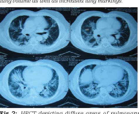 Figure 2 from Acute interstitial pneumonia (hamman-rich syndrome) - a life threatening ...