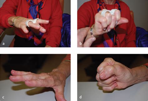 Relative Motion Treatment of Chronic Boutonniere Deformity | Musculoskeletal Key