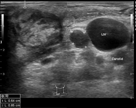 Tuberculous cervical lymphadenitis | Image | Radiopaedia.org