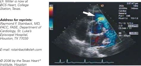 Figure 1 from Supracristal ventricular septal defect. | Semantic Scholar