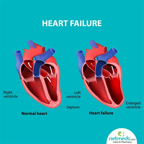 Lv Failure Causes | Natural Resource Department