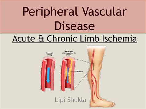 PPT - Peripheral Vascular Disease Acute & Chronic Limb Ischemia ...