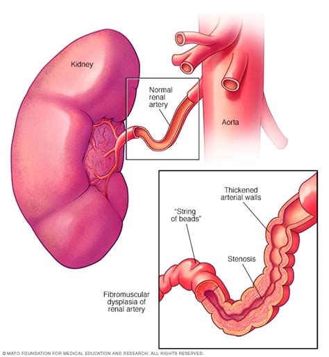 Fibromuscular dysplasia - Symptoms and causes - Mayo Clinic