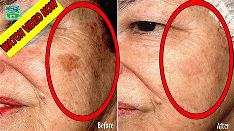 4 Best Natural Remedies To Remove Your Age Spots Completely | Home Remedies - YouTube