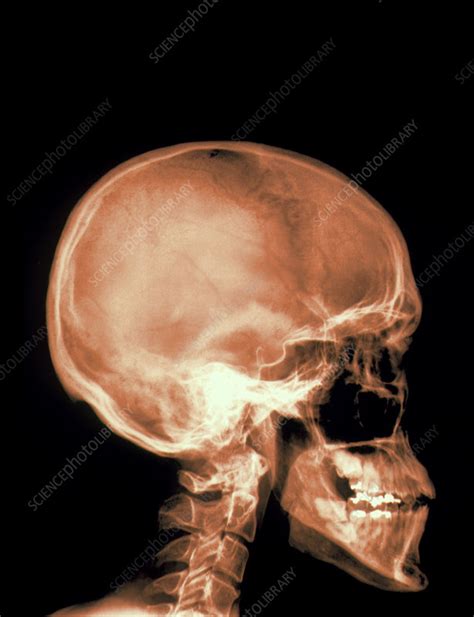 Skull X-ray - Stock Image - P120/0146 - Science Photo Library