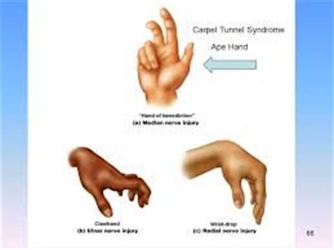 ape hand deformity, wrist drop, claw | Hand therapy, Medical school essentials, Home exercise ...