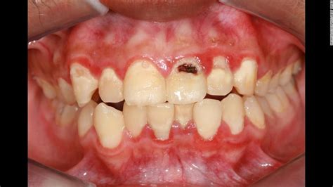 Why do my gums bleed when I brush or floss?: Nikhil M. Patel, DMD: Laser Dentistry