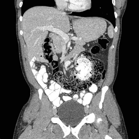 Cecal Bascule – RADIOLOGYPICS.COM