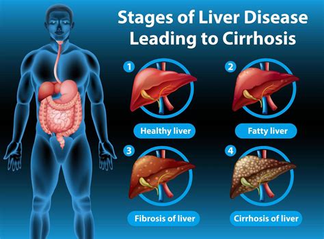 Stages of liver disease leading to cirrhosis 1426676 Vector Art at Vecteezy