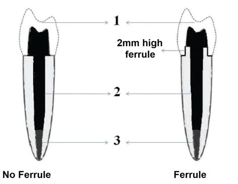 What is Ferrule in Dentistry? | News | Dentagama