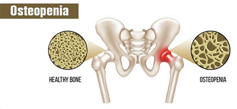 Osteopenia definition, causes, prevention, diet, symptoms, diagnosis ...