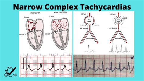 Sinus Tachycardia Vs Atrial Flutter