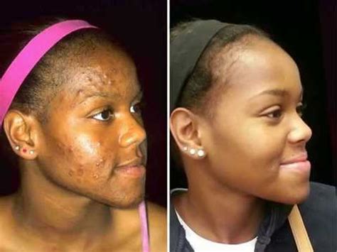 Acne Care for Black Skin - Before & After Images - YouTube