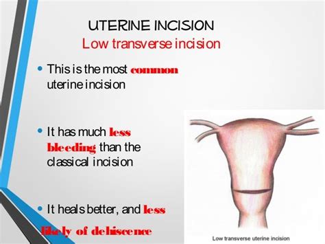 Cesarean Section - CS