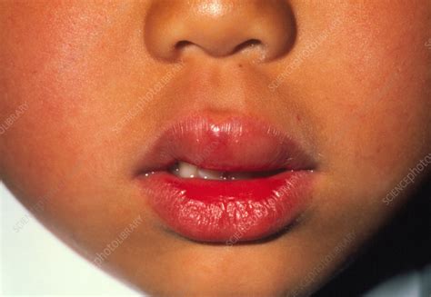 Swollen lip of boy due to peanut allergy - Stock Image - M320/0207 ...