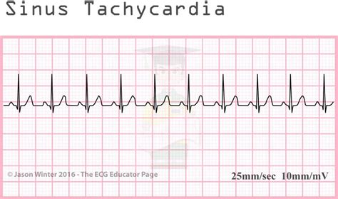 Types of tachycardia. The main types of heart tachycardia on the ECG ...