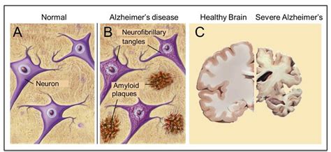 Major pathological hallmarks of AD are amyloid plaques and ...