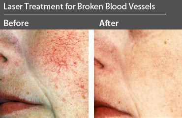 How To Repair A Broken Blood Vessels And The Face - Fowler Thavest