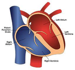 Patent Foramen Ovale (PFO) - Divers Alert Network