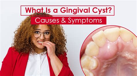 Gingival Cyst Causes, Symptoms & Treatment