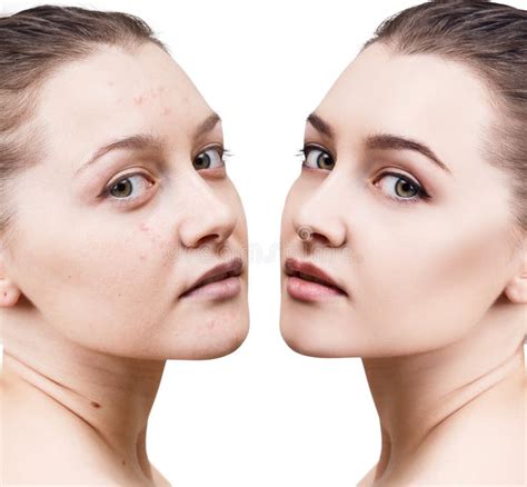 Girl with Acne before and after Treatment Stock Image - Image of acne, cosmetics: 96256457