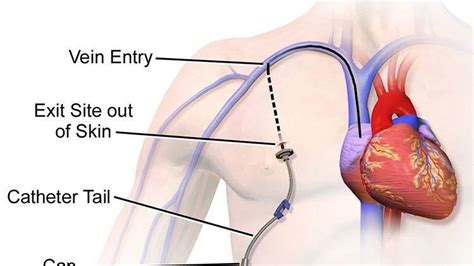 Port-A-Cath 101: How To Access The Port