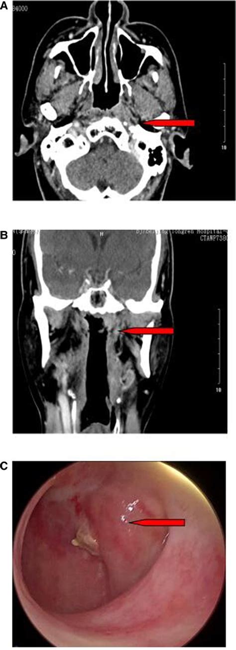 Torus Tubarius Mri