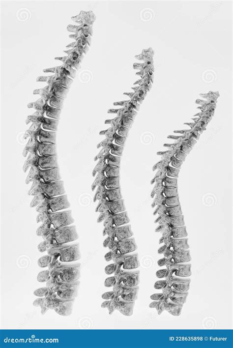 Osteoporosis Curvature Stages of the Spine - 3D Rendering Stock ...