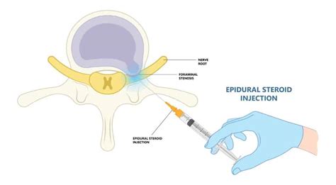 Comparing PRP and steroid injection for back pain - Joint Rehab and ...